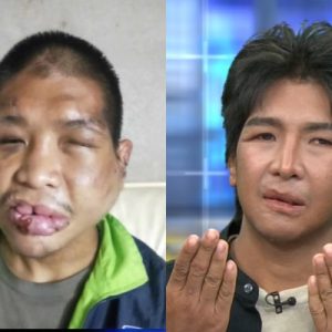 ชีวิตใหม่ “น้องฟ้า” เหยื่อทารุณกรรม ศัลยกรรม 11 ครั้ง 4 ล้าน ผันตัวเลี้ยงไก่